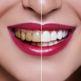 teeh-whitening
